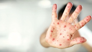 Bakan'dan maymun çiçeği açıklaması: Türkiye'de vaka yok